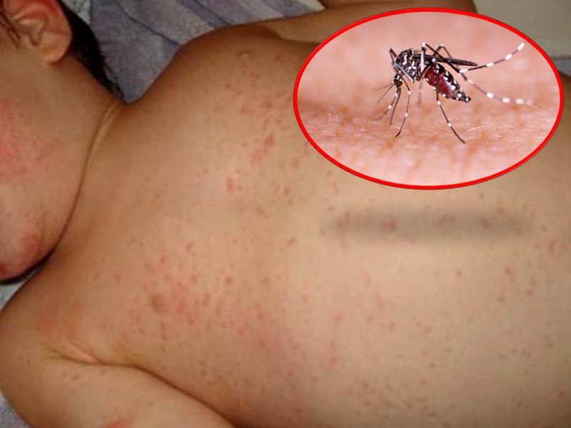 Tác nhân gây ra bệnh sốt xuất huyết và cách phòng chống